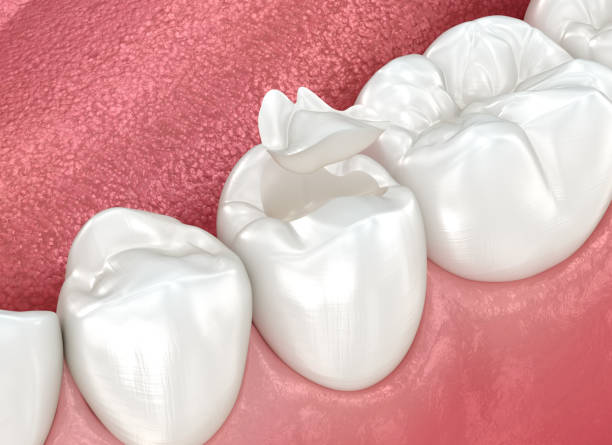 Best Teeth Whitening  in Cocoa West, FL